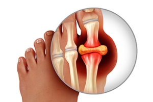 How Gout and Pseudogout Differ