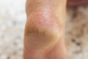Cracked Heels and Protecting Foot Health