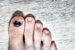 When to See a Podiatrist for Toenail Trauma