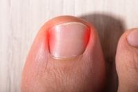 Causes and Preventive Measures for Ingrown Toenails