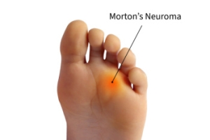 Burning Pain Between the Toes