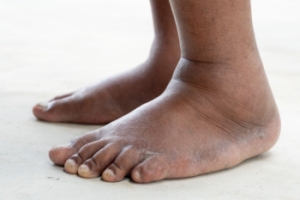 Risks and Causes of Swollen Feet and Ankles