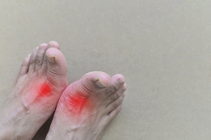 When Sudden Joint Pain Signals Gout