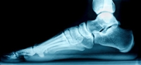 Potential Complications of Flat Feet