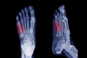 Outer Foot Pain Can Be an Avulsion Fracture