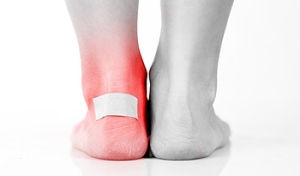 Insect Bites, Shoes, and Socks May Form Blisters
