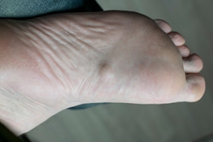 Facts About Plantar Fibromas
